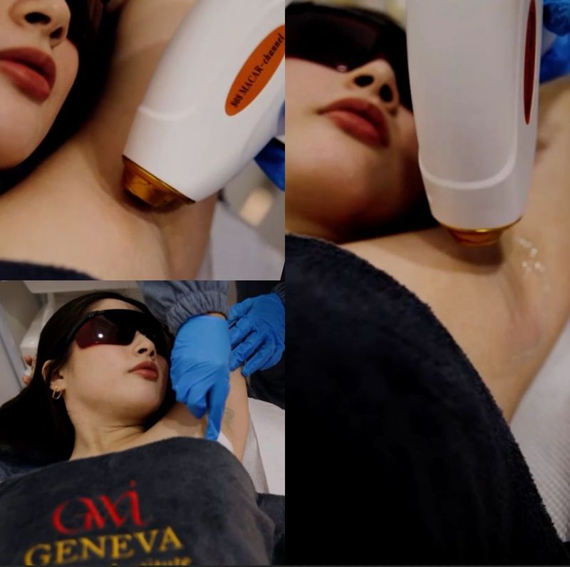 Laser Hair Removal Treatment Laser Hair Removal